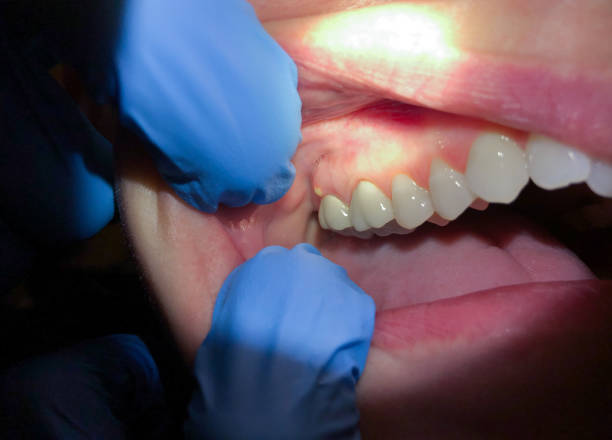 Best Emergency Dental Care for Broken or Chipped Teeth in Langley, SC